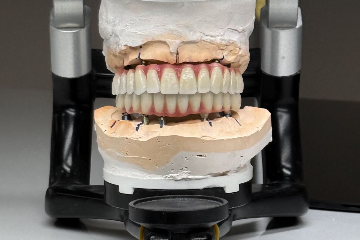 Full-mouth crown restoration on an articulator